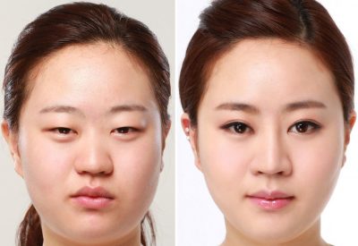 Chỉnh sửa đôi mắt sụp mí bằng công nghệ cắt mí hiện đại