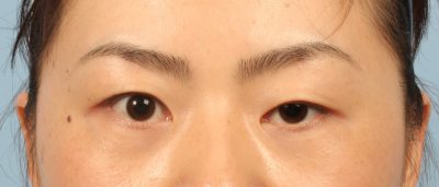 Tình trạng sụp mí mắt khiến đôi mắt mất thẩm mỹ