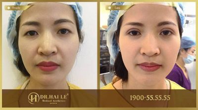 Kết quả sau khi thẩm mỹ sụp mí mắt tại Dr.Hải Lê