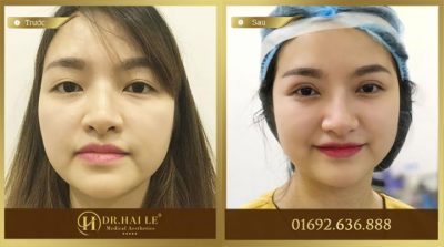 Bạn gái tươi trẻ sau khi thực hiện cắt mí Mani Mini Deep 5D Bạn gái tươi trẻ sau khi thực hiện cắt mí Mani Mini Deep 5D