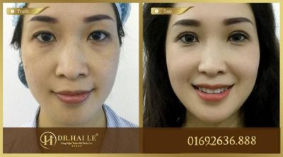 Kết quả khắc phục mắt 1 mí, sụp mí tại Dr.Hải Lê. Kết quả khắc phục mắt 1 mí, sụp mí tại Dr.Hải Lê.
