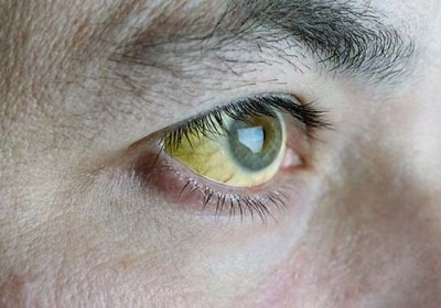 Đôi mắt đang tiết lộ điều gì về sức khỏe 5