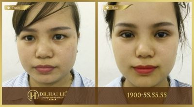 Kết quả cắt mí sụp tại Dr.Hải Lê Nâng mí mắt bị sụp