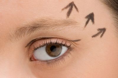 Vì sao có hiện tượng sụp mí mắt Nâng mí mắt bị sụp