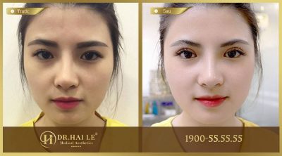 Cắt mí mắt trên ở đâu đẹp và an toàn?