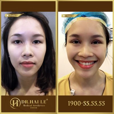 Ảnh trước sau double deep 5d