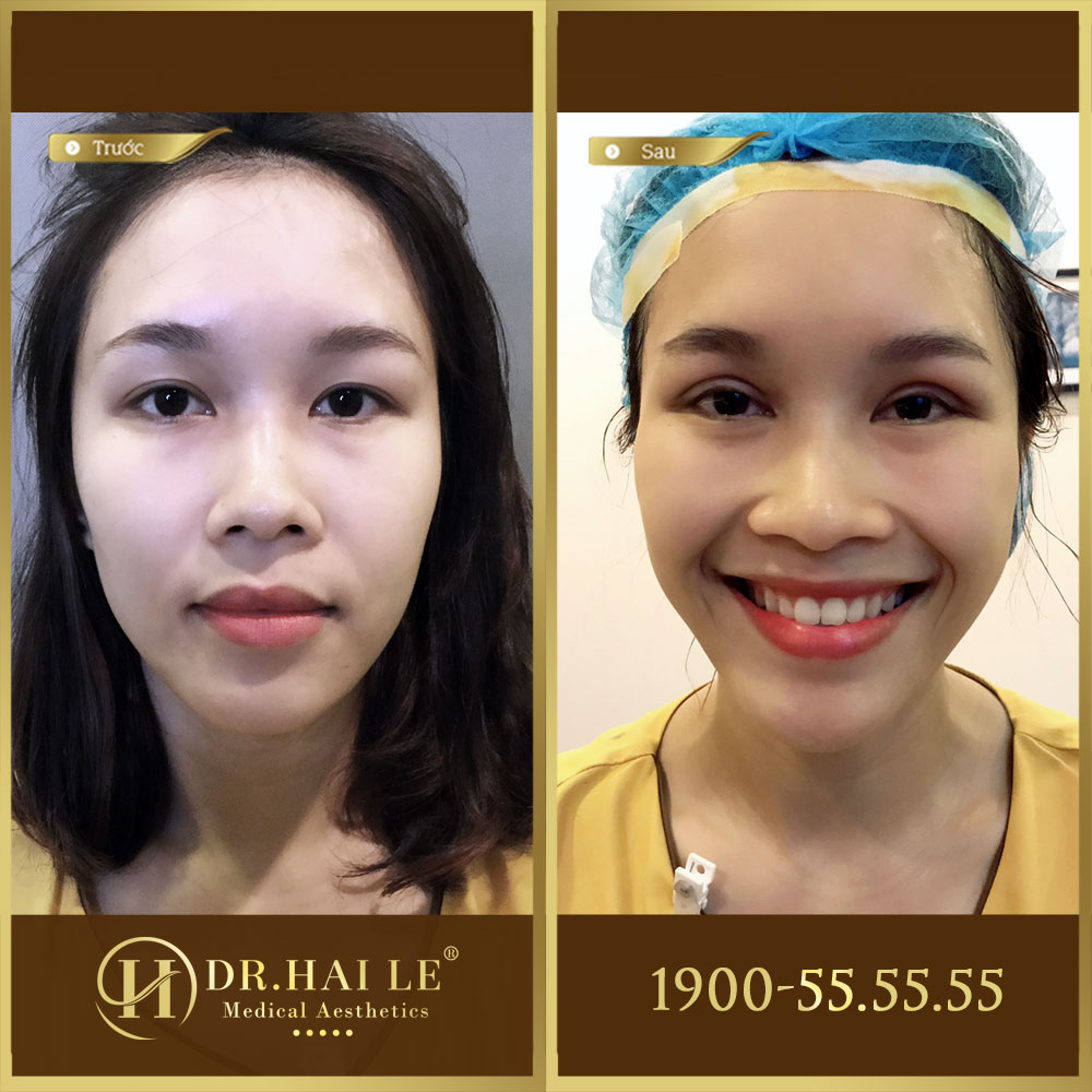 Ảnh trước sau double deep 5d