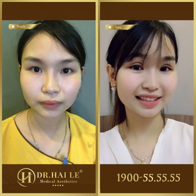 Ảnh trước sau double deep 5d