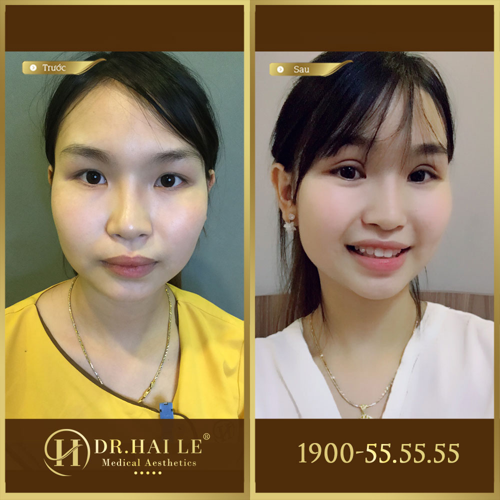 Ảnh trước sau double deep 5d