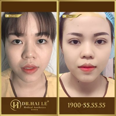 Ảnh trước sau double deep 5d