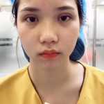 Hình ảnh sau khi cắt mí mắt Double Deep 5D Tại Dr Hải Lê