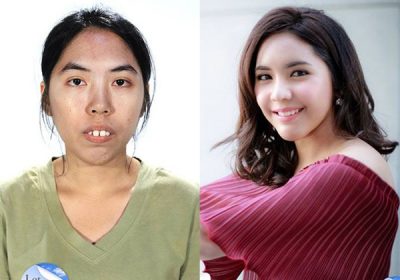 Đàn ông nói gì về phụ nữ đi phẫu thuật thẩm mỹ