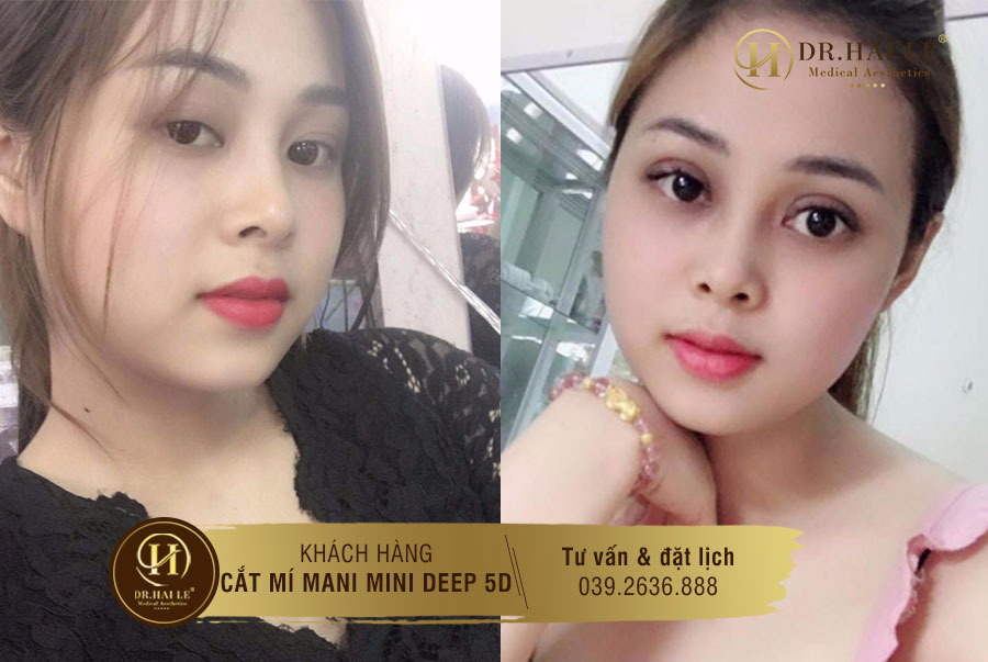 Ảnh trước và sau cắt mí mắt