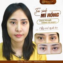 cắt mí mắt bị hỏng hình ảnh