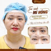 cắt mí mắt bị hỏng hình ảnh